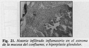 Hiperplasia glandular