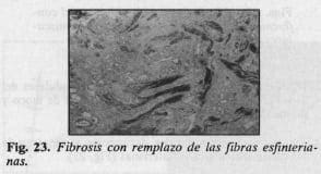 Fibrosis con remplazo de las fibras esfinterianas