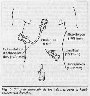 Inserción de los trócares para la hemicolectomía derecha