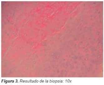 Resultado de la biopsia