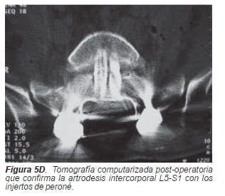 Artrodesis intercorporal L5-S1