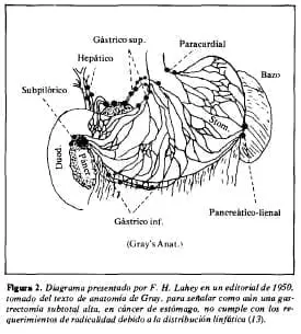 Gastrectomia subtotal alta