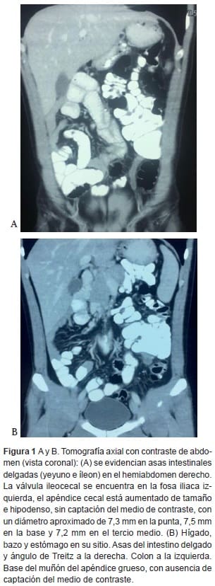 Apendicitis aguda, Tomografía axial con contraste de abdomen