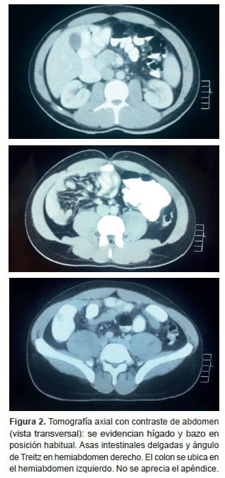 Apendicitis aguda, Tomografía axial con contraste de abdomen