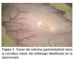 Tumor del estroma gastrointestinal