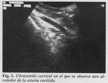 Drenaje Quirúrgico Cervicotorácico, Ultrasonido cervical