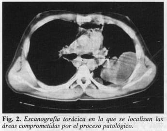 Drenaje Quirúrgico Cervicotorácico, Escanografía torácica