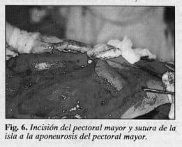 Aponeurosis del pectoral mayor - Colgajo Musculocutáneo