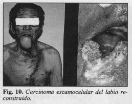 Carcinoma escamocelular del labio - Colgajo Musculocutáneo del Pectoral