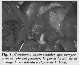 Carcinoma escamocelular - Colgajo Musculocutáneo