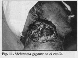 Melanoma gigante en el cuello - Colgajo Musculocutáneo