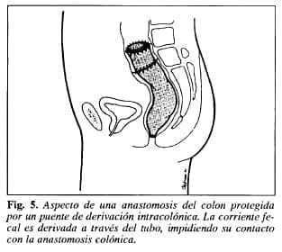 Aspecto de una anastomosis del colon - Tubo de Derivación Intracolónica