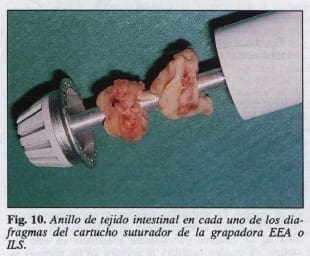 Anillo de tejido intestinal