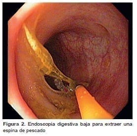 Perforación de Colon, endoscopia digestiva baja