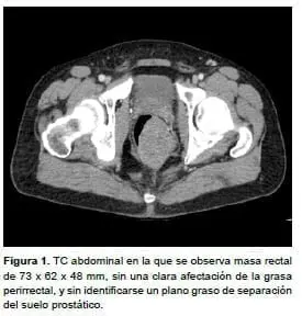 Tumor del estroma gastrointestinal rectal, masa rectal