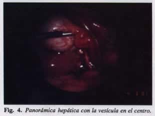 Panorámica hepática con la vesícula