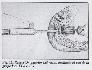 Resección anterior del recto