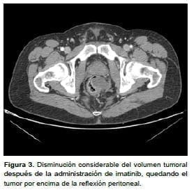 Tumor del estroma gastrointestinal rectal, volumen tumoral