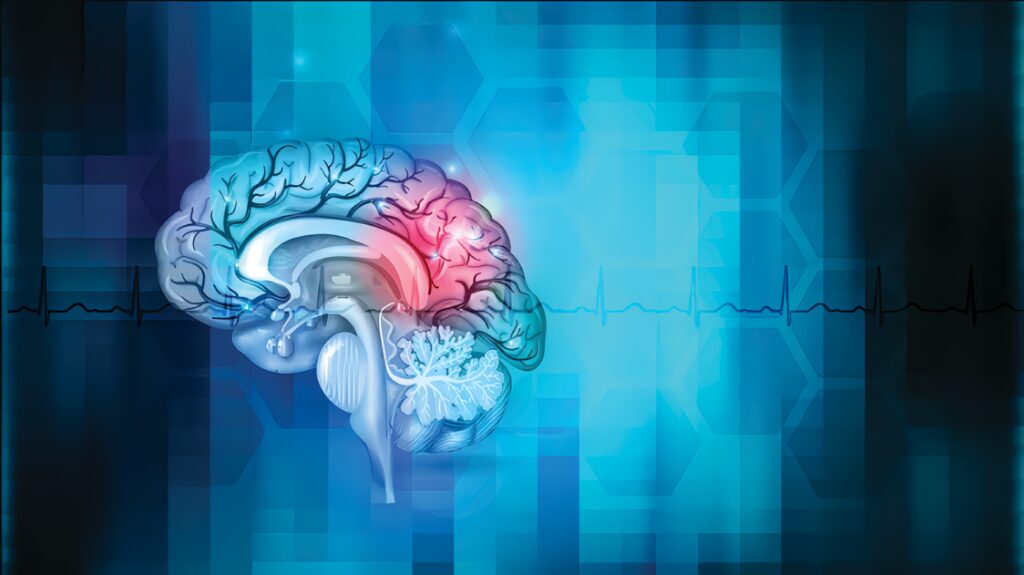 Accidente Cerebro Vascular o ACV