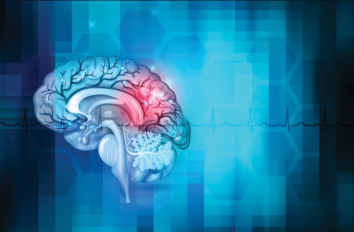 Accidente Cerebro Vascular o ACV