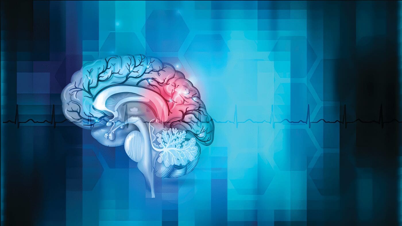 Accidente Cerebro Vascular o ACV