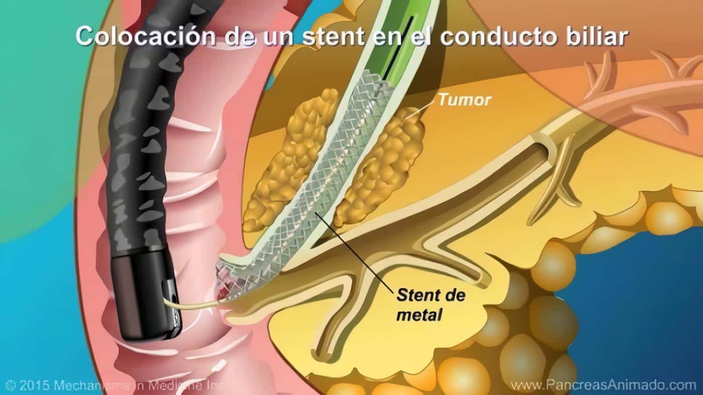 Colangiopancreatografía -CPRE