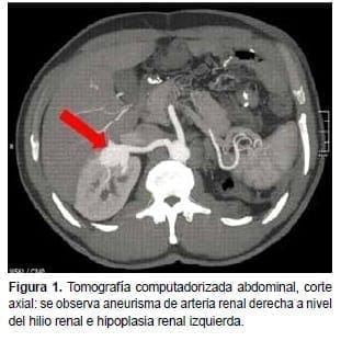 Aneurisma de Arteria Renal, Corte Axial