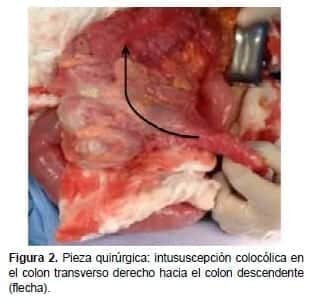 Intususcepción Colocólica, Pieza quirúrgica