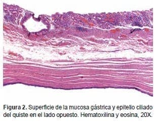 Superficie de la Mucosa Gástrica