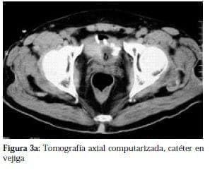 Tomografía axial computarizada, Catéter en Vejiga
