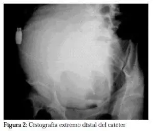 Cistografía extremo Distal del Catéter