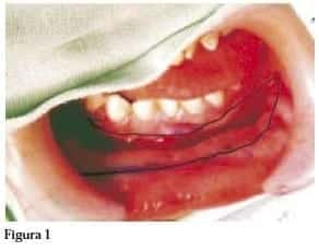 Defecto Oral se cerró con ácido Poliglicólico