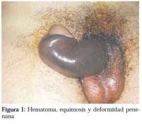 Hematoma, Equimosis y deformidad Penenana
