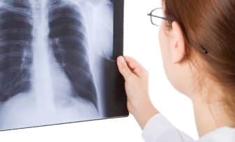 Derrame Pleural en Radiografías