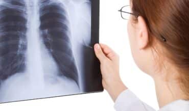 Derrame Pleural en Radiografías
