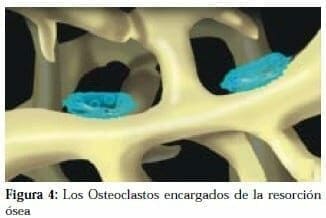 Osteoclastos encargados de la resorción Ósea