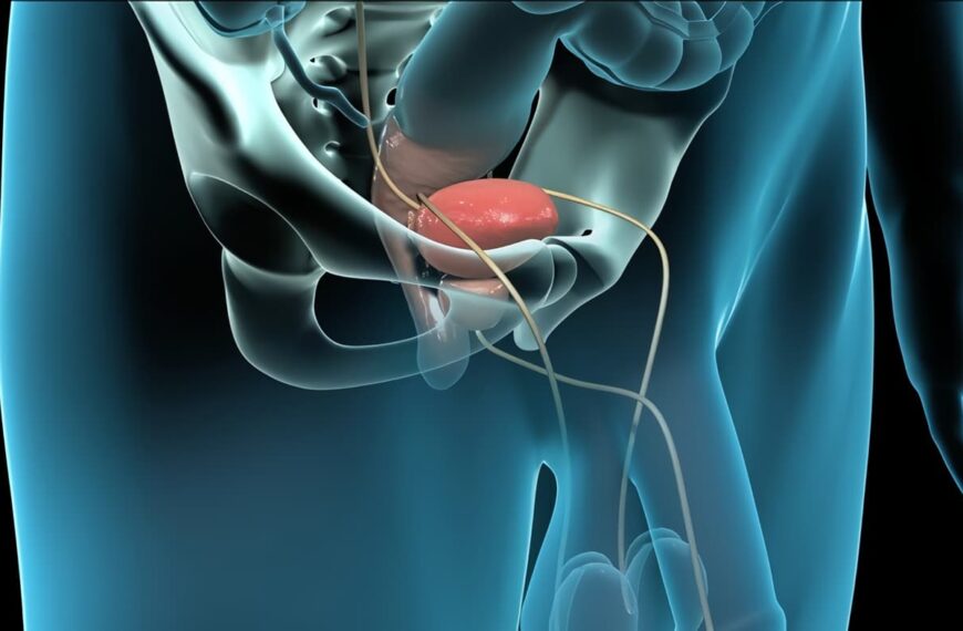 Disfunción Erectil Post Prostatectomia Radical