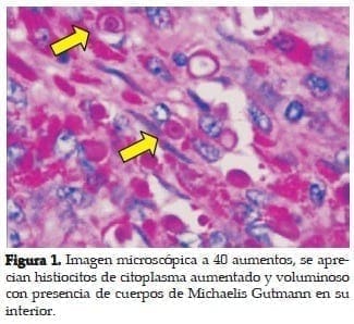 Histiocitos de Citoplasma aumentado y voluminoso