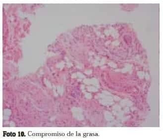 Adenocarcinoma de Próstata: Compromiso de la grasa