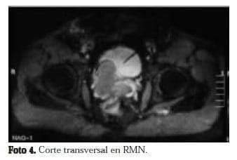 Corte transversal en RMN