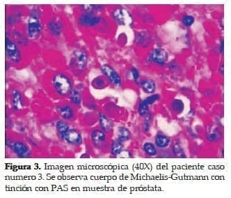 Cuerpo de Michaelis-Gutmann con Tinción con PAS en muestra de Próstata