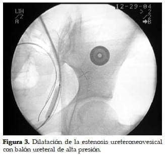 Dilatación de la Estenosis Ureteroneovesical