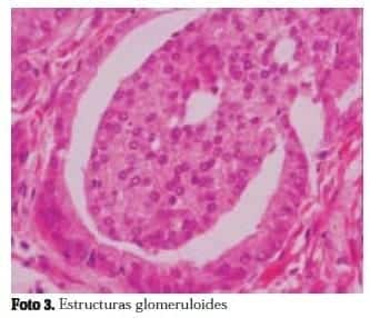 Estructuras Glomeruloides