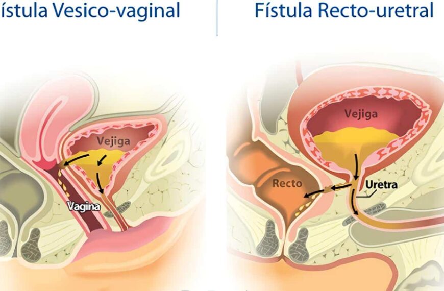 Fístulas Vesicovaginales