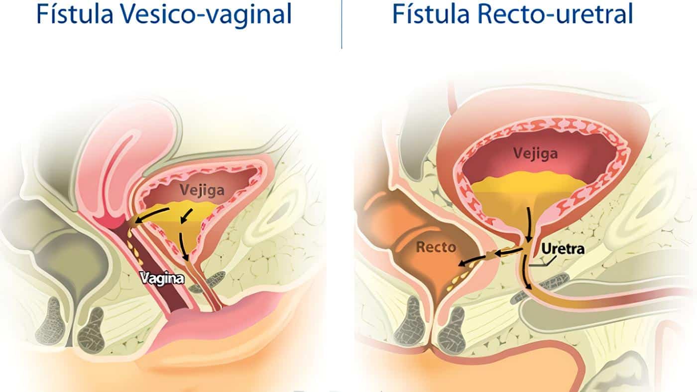 Fístulas Vesicovaginales