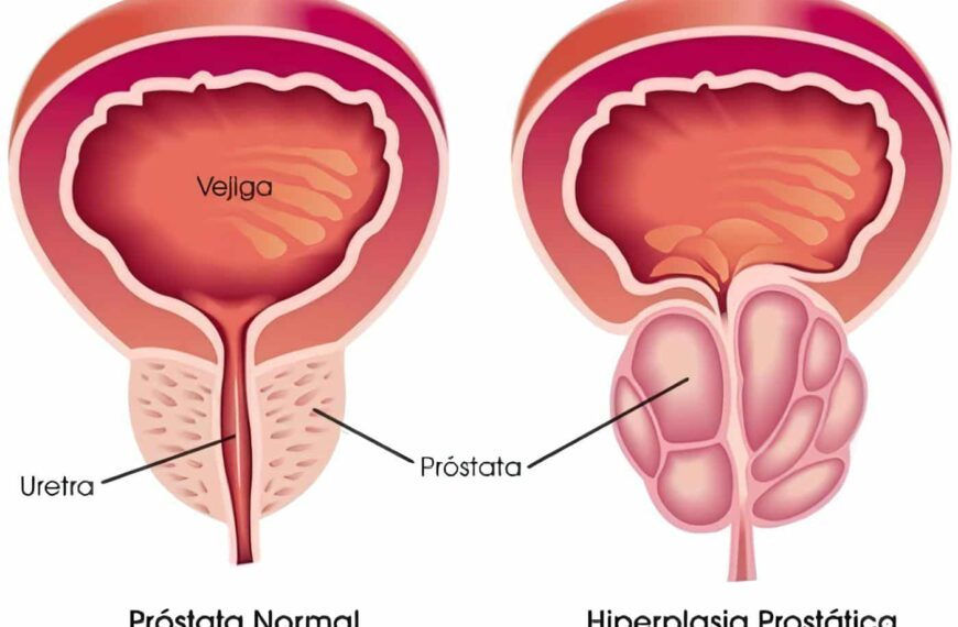 Tamsulosina Estudio de Bioequivalencia, Hiperplasia Prostática