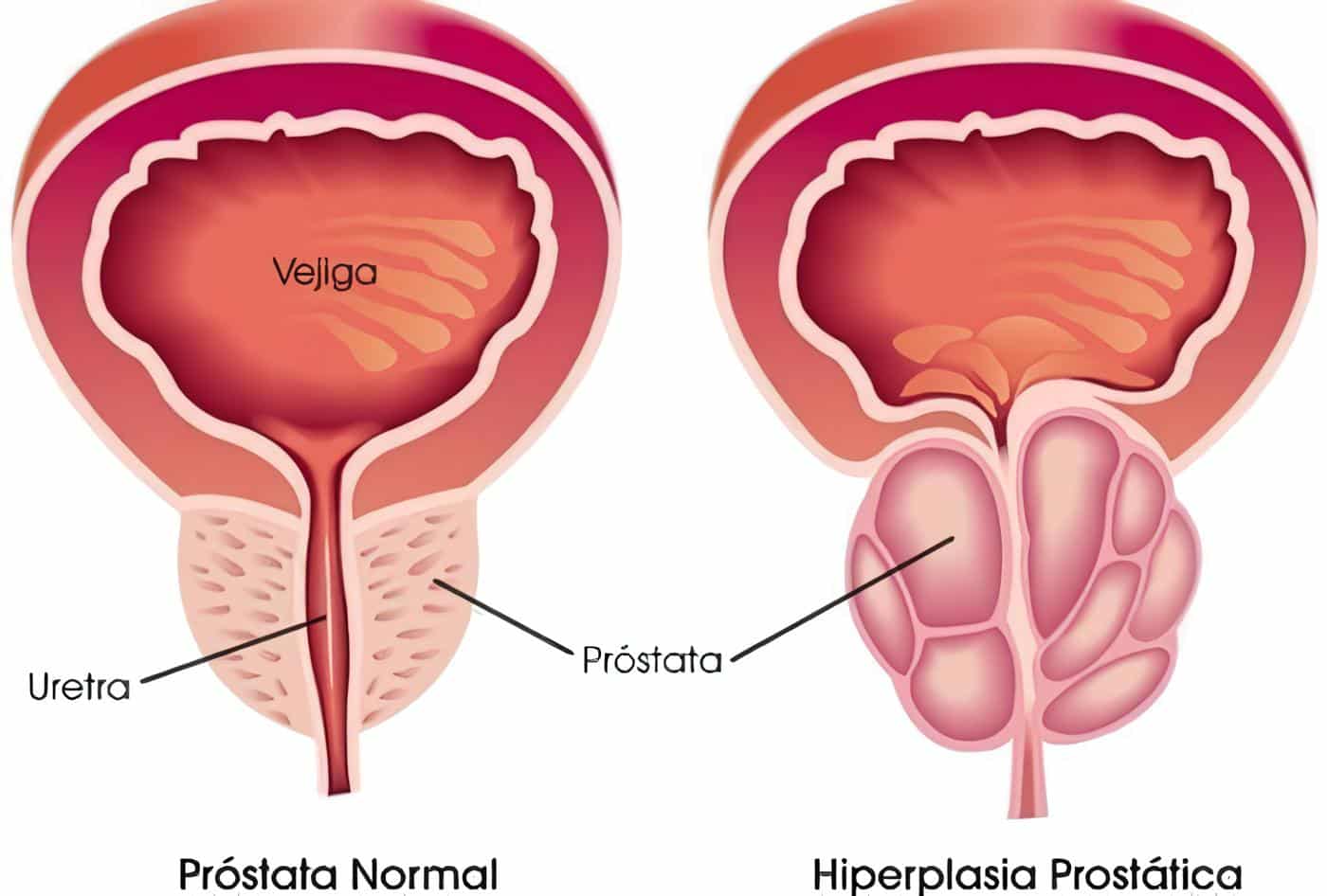 Tamsulosina Estudio de Bioequivalencia, Hiperplasia Prostática