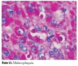 Adenocarcinoma de Próstata: Malacoplaquia