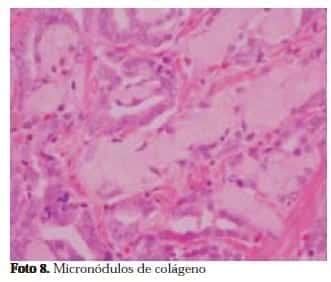 Micronódulos de colágeno