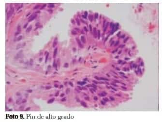 Adenocarcinoma de Próstata: Pin de alto grado